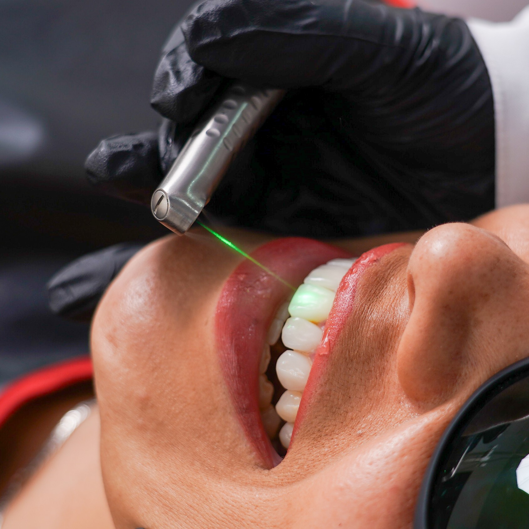 Láser Fotona - Image 4